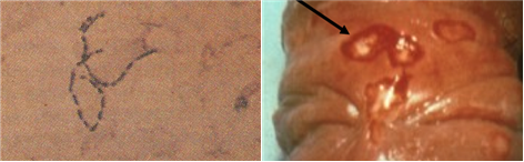 헤모필루스 듀크레이 궤양